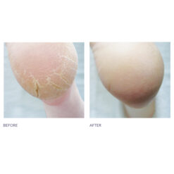 Cracked Heel Formula #3+