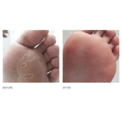 Peeling Skin Formula #7